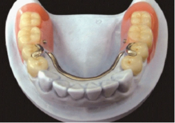 镶牙后牙龈萎缩怎么办 镶牙后牙龈萎缩怎么恢复