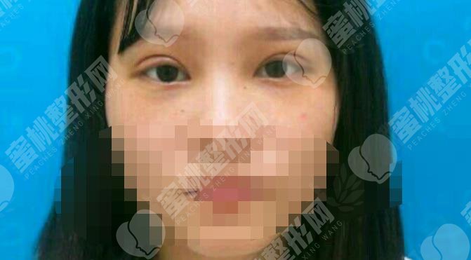 做双眼皮手术之后