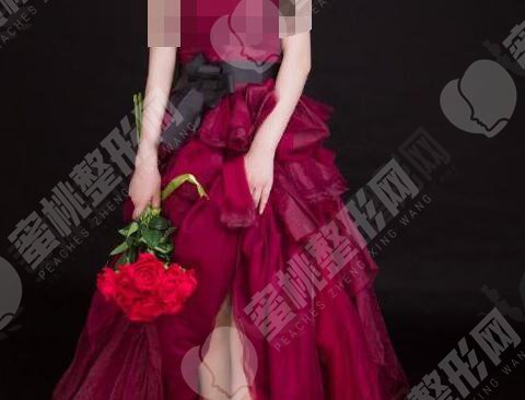 大腿吸脂术后20天