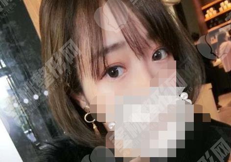 做双眼皮手术之后