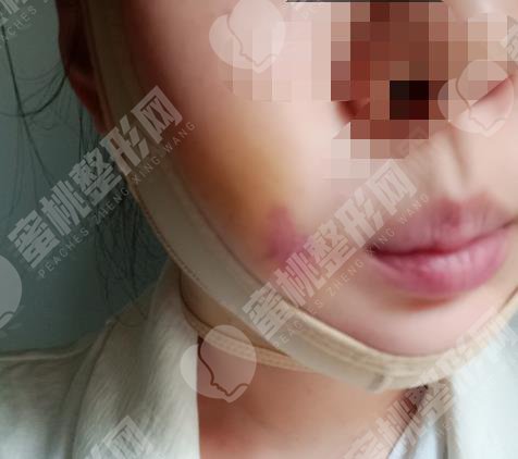 做注射瘦脸之后