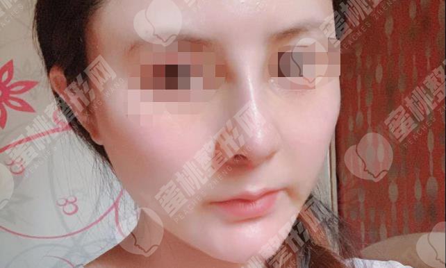 做隆鼻手术之后