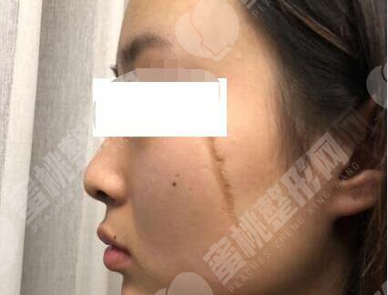 祛疤术前
