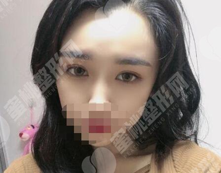 双眼皮术后30天