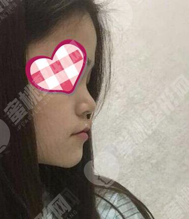 做隆鼻手术之前