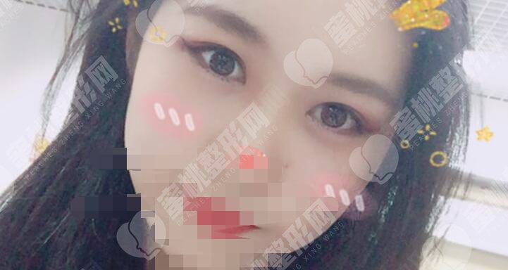 双眼皮术后30天