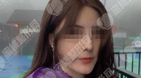 做隆鼻手术之后