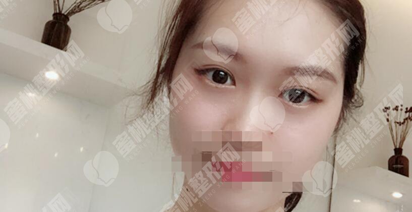 双眼皮术后60天