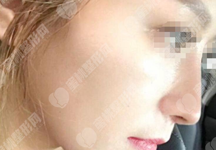 做隆鼻手术之后