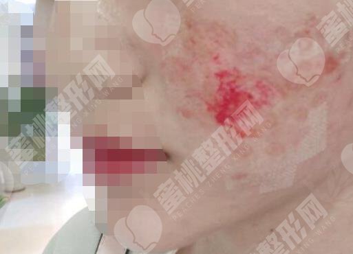 做面部去疤手术之前