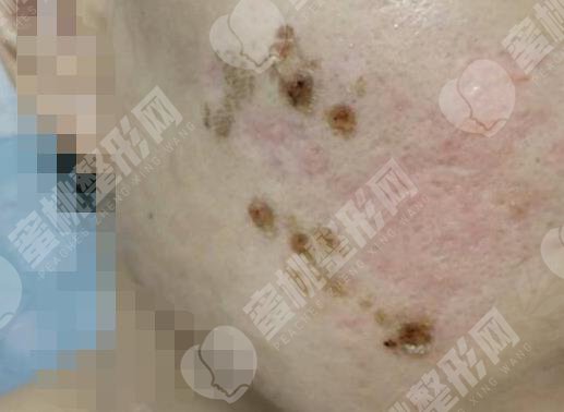 做面部去疤手术过程