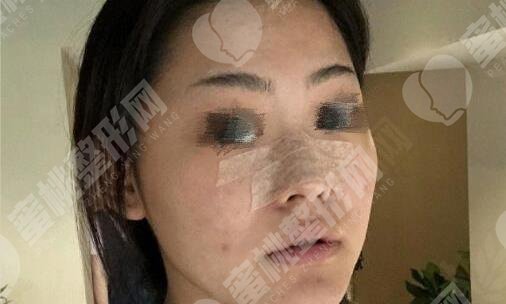 做隆鼻手术过程