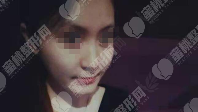 做隆鼻手术之前