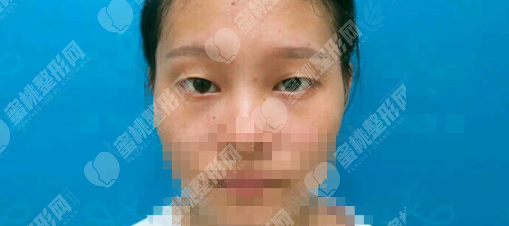 做双眼皮手术之前