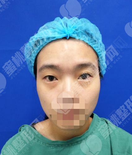 上海华美开双眼皮的真实过程记录贴~来看果吧